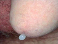 Nhiễm Chlamydia trachomatis